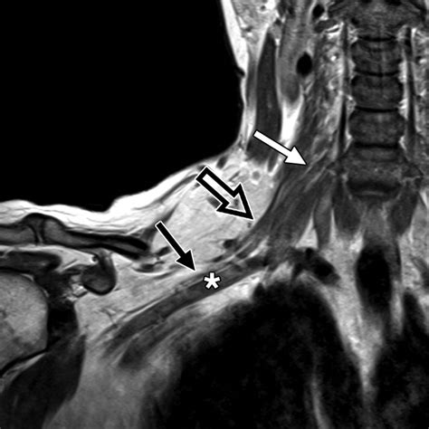 Brachial Plexus Mri Protocol