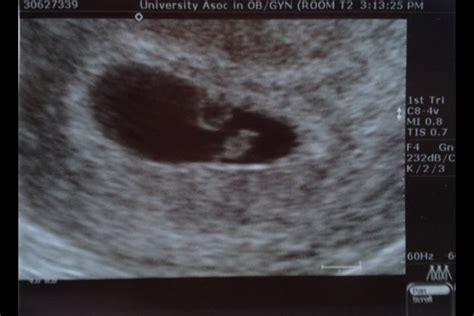 6 week ultrasound ??? - BabyCenter