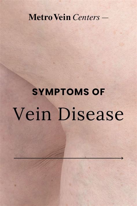 Symptoms Of Vein Disease