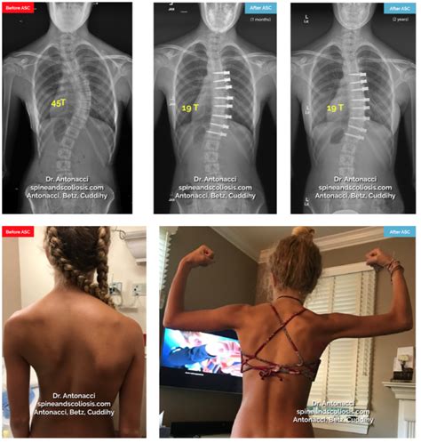 Scoliosis Surgery Before and After