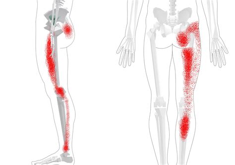 Buttocks Trigger Points Overview Tips And Exercises