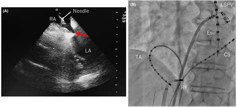 A Image Of Atrial Transseptal Puncture The Tenting Image Red Arrow