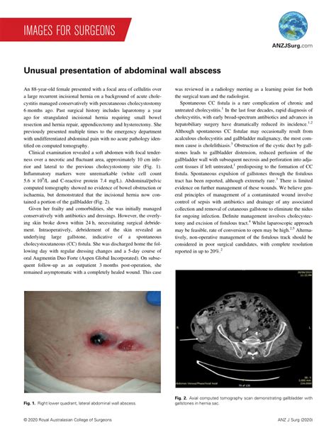 Cutaneous Abscess Of Abdominal Wall