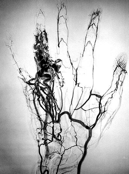 Angiography - Wikipedia