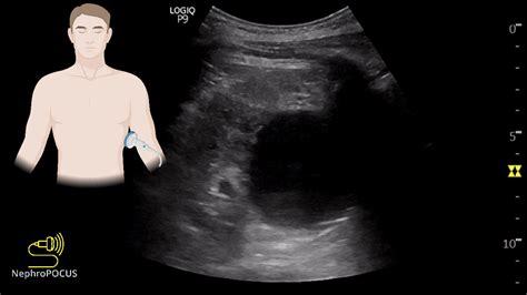 NephroPOCUS On Twitter POCUS Quiz Setting Nephrology Clinic