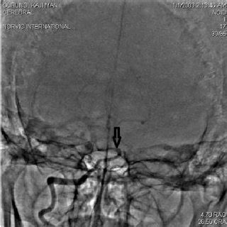 Rt Vertebral Artery with hypoplastic Basilar Artery (marked with arrow) | Download Scientific ...