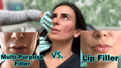 Lip Fillers Compared To Restylane Juvederm Versus