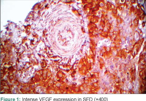 severe epithelial dysplasia | Semantic Scholar