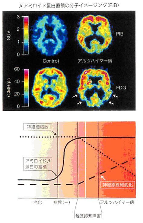 Pet アミロイドイメージングによるアルツハイマー病診断の研究動向
