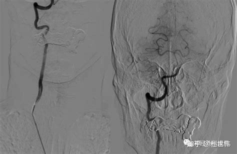 “盗血”笔记——锁骨下动脉盗血综合征 知乎