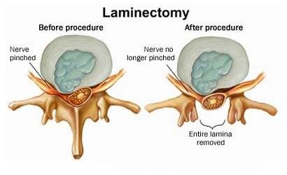 Hemilaminectomy Vs Laminectomy