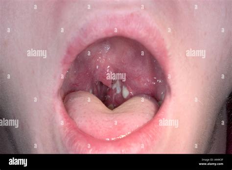 strep throat infection Stock Photo - Alamy