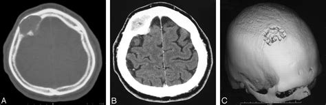 Primary Intraosseous Meningioma Ct And Mri Appearance American