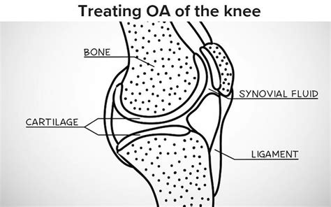 7 symptoms of arthritis in the knee – Artofit