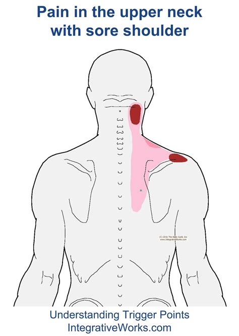 Upper neck pain with sore top of shoulder – Artofit