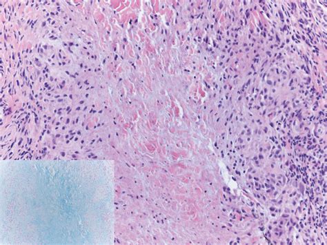 Multiple Nontender Subcutaneous Nodules On The Finger Mdedge Dermatology