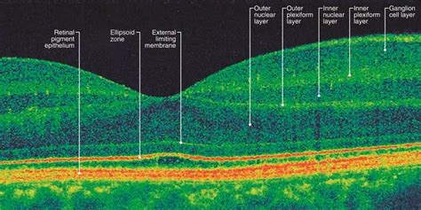 What Is Optical Coherence Tomography? - American Academy of Ophthalmology