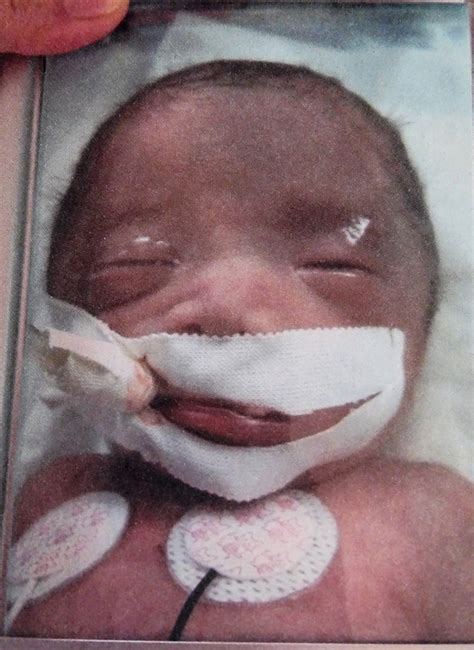 Premature baby born at just 28 weeks defies the odds