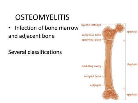 Ppt Osteomyelitis Powerpoint Presentation Free Download Id9192874