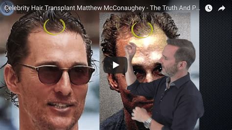 MATTHEW MCCONAUGHEY HAIR TRANSPLANT - THE REAL TRUTH!