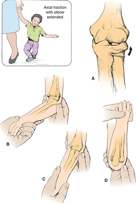 Nursemaid's Elbow - Children's Bone and Spine Surgery