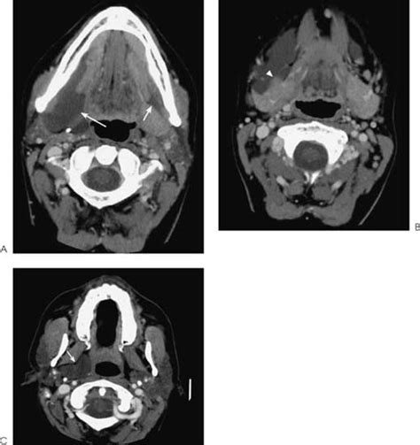 Simple Ranula | Radiology Key