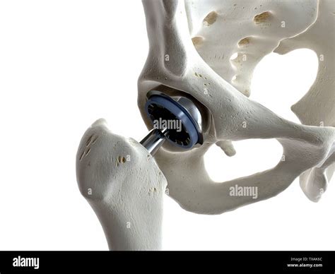 Hip Replacement Hi Res Stock Photography And Images Alamy