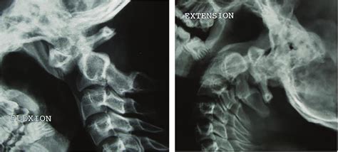 Upper Cervical Spine Computed Tomography Clinical Tree