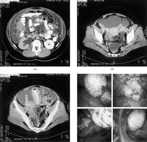 A Year Old Woman With A Peritoneal And Omental Lymphomatosis By