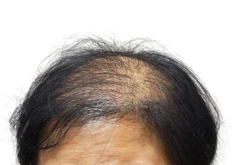 Telogen Effluvium | Female Hair Loss Information | Mark Glenn Hair