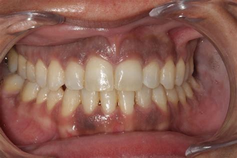 Enc As Negras O Melanosis Gingival Esprohident