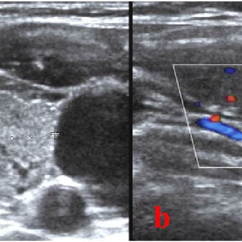 The Results of Doppler Ultrasound for Thyroid Gland. The thyroid gland ...