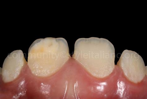 Minimally Invasive Approach In Treating White Spot Lesion Using Icon