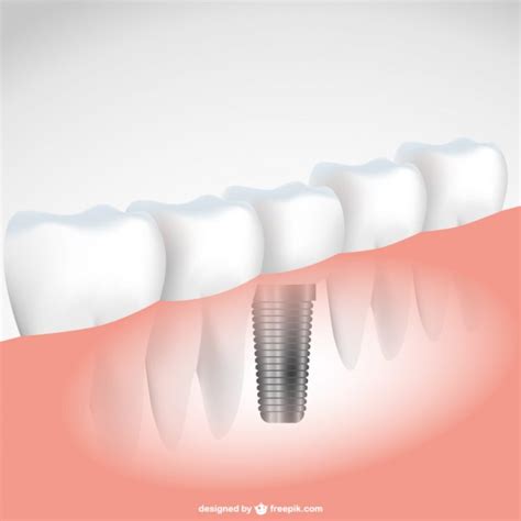 Dental Implants A Guide To Revitalize Your Smile