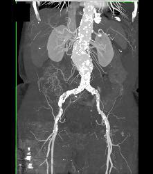 Abdominal Aortic Aneurysm AAA With Peripheral Vascular Disease PVD