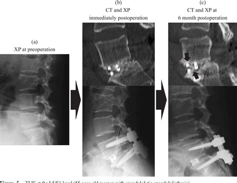 Figure 5 From Comparison Of Transforaminal Lumbar Interbody Fusion Using The Boomerang Shaped