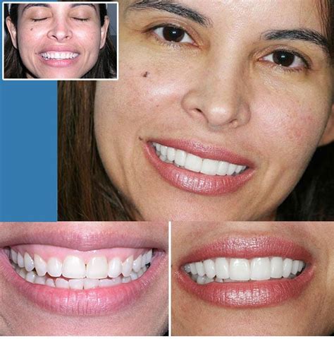 Lumineers Vs Veneers Before After