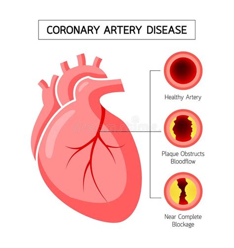 Coronary Artery Disease Concept in Flat Style Stock Vector - Illustration of care, anatomy ...