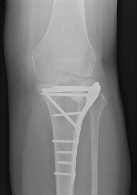 The Outcome Following Fixation Of Bicondylar Tibial Plateau Fractures