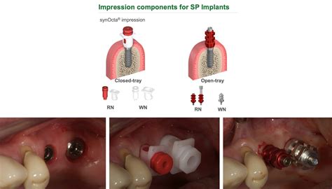 The Benefits Of Tissue Level Implants Restoratively ITI Blog