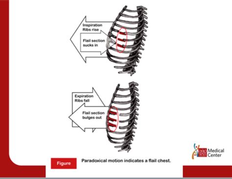 Flail Chest Diagram