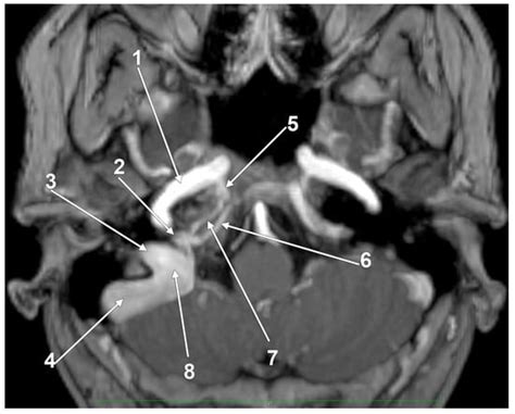 Medicina Free Full Text Anatomical Variations Of The Jugular Bulb