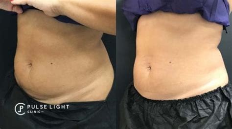 Coolsculpting Fat Freezing Treatment London Pulse Light Clinic London