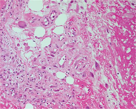 Fibroblastic And Myofibroblastic Tumors Clinical Tree