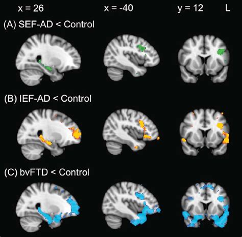 VBM Analyses Showing Brain Regions Of Decreased Grey Matter Intensity