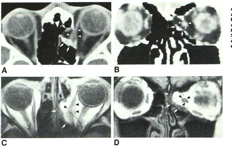 Figure From Surface Coil Mr Imaging Of Orbital Blowout Fractures A