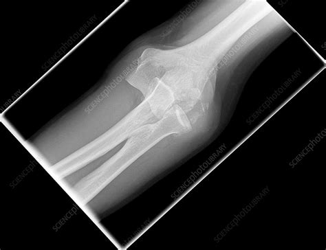 Dislocated Elbow X Ray Stock Image C Science Photo Library