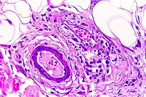 Premium Photo | Photomicrograph of granulomatous tissue histology ...