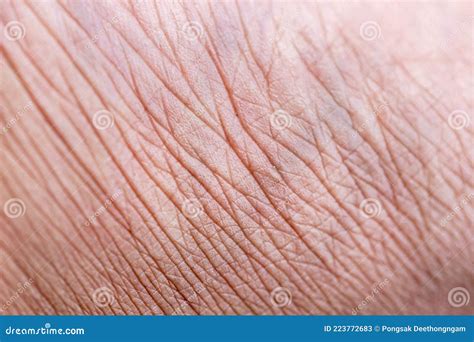 Closeup View Of Feet With Dry Skin Cracks Stock Image Image Of Human