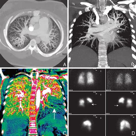 Idiopathic Pulmonary Arterial Hypertension Pah In A Year Old